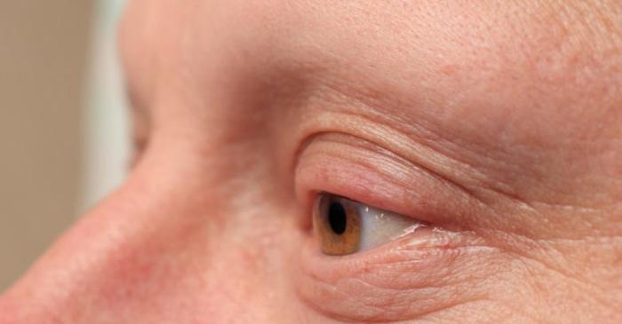 Cancerul de ochi: care sunt semnele și simptomele?
