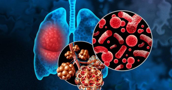 Un medic pneumolog explică legătura periculoasă dintre gripă și plămâni