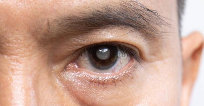 Blefaroplastia, operația care atrage tot mai mulți bărbați în cabinetele estetice