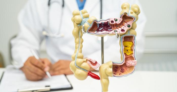 Cancerul colorectal: cum poate fi prevenită boala la tineri?