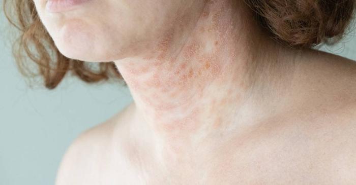 Dermatita atopică afectează un copil din cinci în România, dar tratamentele balneare oferă speranță