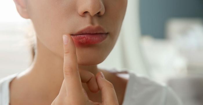 În ce perioadă rămâi contagios când ai herpes bucal?