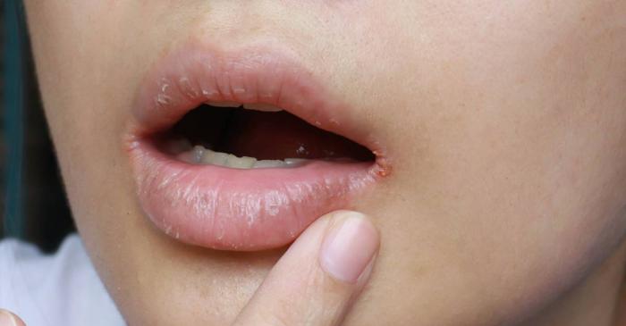 Care sunt simptomele subtile ale anomaliei Ebstein?