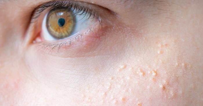 Mierea, remediul natural eficient pentru eliminarea miliilor de pe față