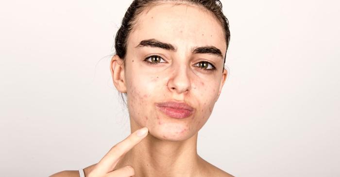 Zincul, aliatul neașteptat în lupta împotriva acneei: cum acționează și când să îl folosești