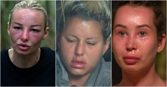 Fețele umflate ale concurenților de la Survivor România: adevărul din spatele transformărilor fizice