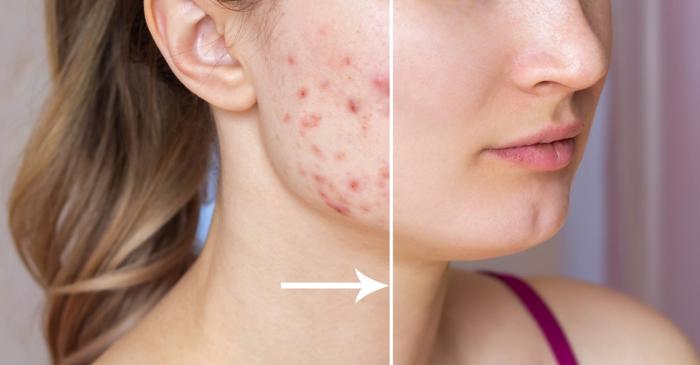 Cuburile de gheață cu semințe de in, remediul natural care transformă tenul problematic