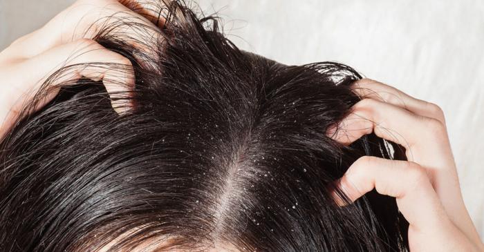 Cinci tratamente naturale care combat eficient scalpul uscat