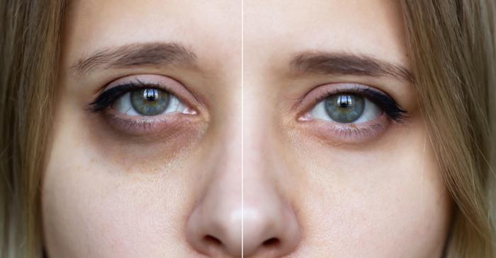 Uleiul de migdale și Vaseline, aliații accesibili împotriva cearcănelor cauzate de uscăciune