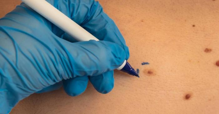 Ce afecțiune gravă poate fi confundată cu un simplu papilom?