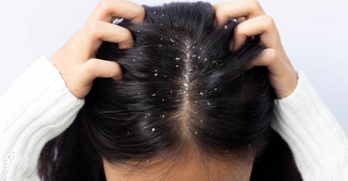 Două rețete naturale din bucătărie combat mătreața și calmează scalpul iritat