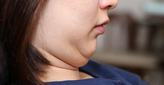 Exercițiile faciale simple reduc bărbia dublă cauzată de privitul în telefon