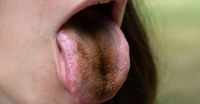 De ce își poate schimba limba culoarea în negru?