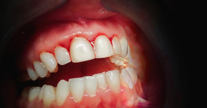 De ce nu ar trebui să ignori niciodată sângerarea gingiilor?