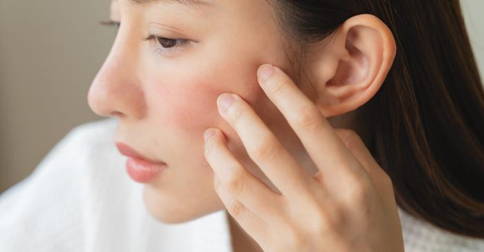 Frigul și aerul uscat destabilizează bariera naturală de protecție a pielii sensibile