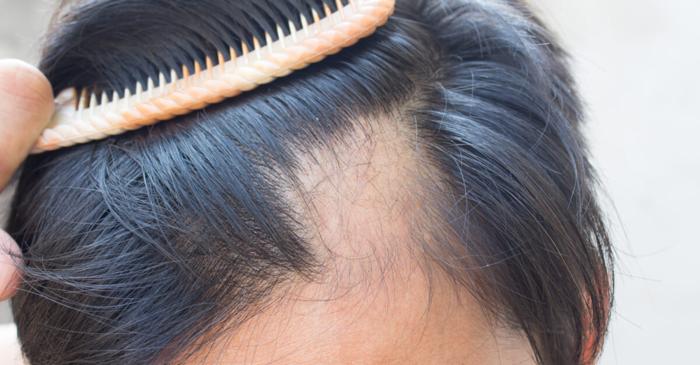 Un medic dermatolog explică de ce căderea părului semnalează deseori probleme de sănătate ascunse