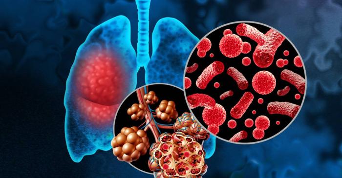 Pneumonia se deosebește de răceală prin respirația dificilă și febra mare