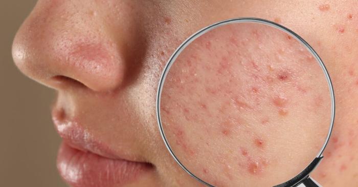 Soluțiile naturale pentru acneea juvenilă care funcționează cu adevărat