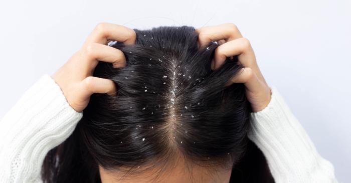 Ce greșeală comună te împiedică să scapi definitiv de mătreață?