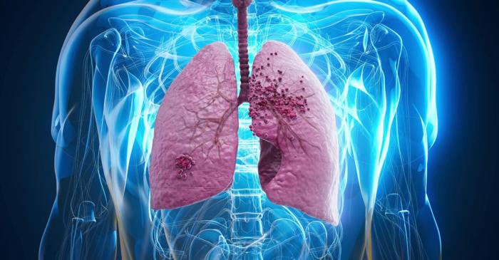 Celulele canceroase dormante explică de ce boala revine după ani de vindecare