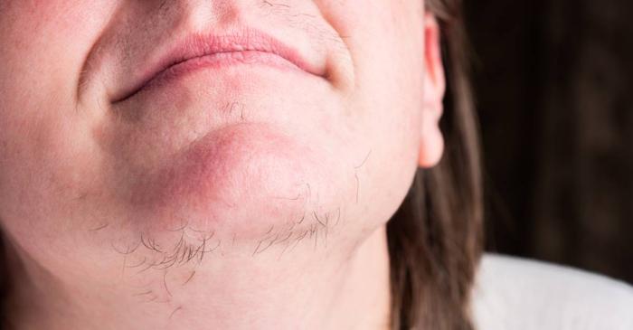 Părul facial la femei poate indica dezechilibre hormonale și probleme de sănătate