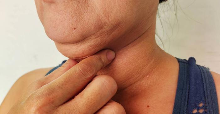 Un chiropractor american propune un exercițiu simplu cu mingea de tenis pentru reducerea bărbii duble