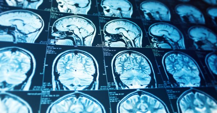 Grupa de sânge A crește riscul de accident vascular cerebral la tineri