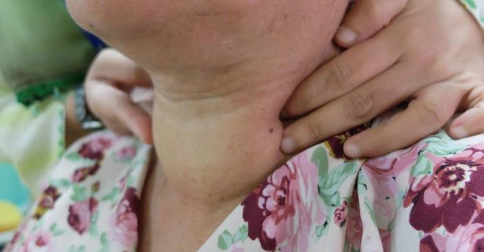 Ce afecțiune medicală sabotează eforturile de a slăbi?