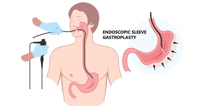 ESG, procedura endoscopică care micșorează stomacul fără cicatrici, oferă rezultate de două ori mai bune decât balonul gastric