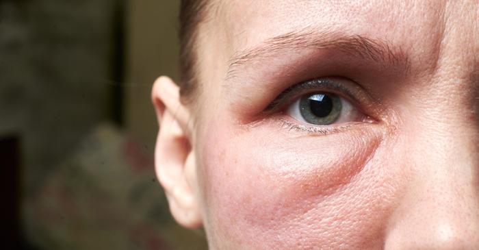 Ochii umflați pot indica probleme renale când umflătura persistă