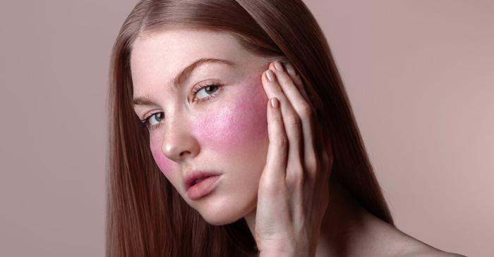 Rozaceea afectează peste 10% din populația adultă și poate fi controlată prin tratament laser vascular personalizat