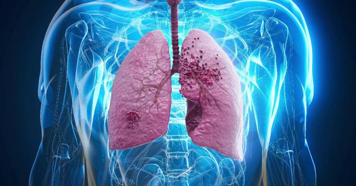 Un specialist demontează 13 mituri despre cancerul pulmonar care pot costa vieți