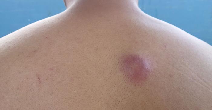 Spargerea furunculului acasă poate duce la complicații severe