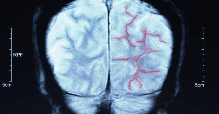 Unele dureri de cap ascund probleme grave ale vaselor cerebrale