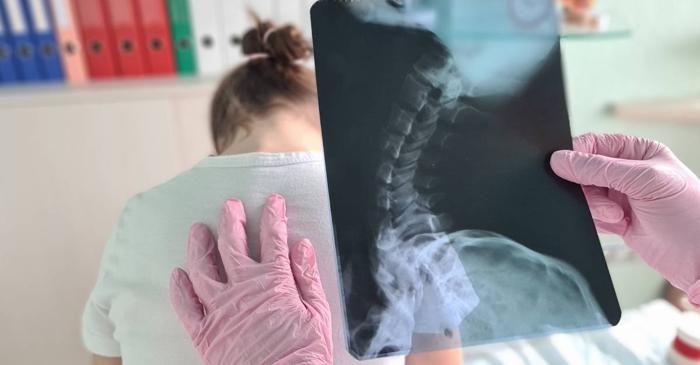De ce apare scolioza la adolescenți, dacă postura și ghiozdanele grele nu au nicio vină?