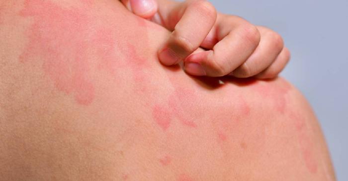 Urticaria cronică spontană mimează perfect o alergie severă, dar mecanismul real este complet diferit